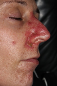 Basal Cell Carcinoma follow-up treatment with Efudex, day 16