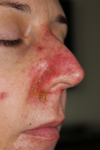 18 days of Efudix follow-up for Basal Cell Carcinoma