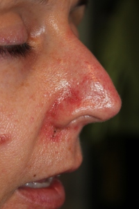Day 9 of Efudix follow-up for Basal Cell Carcinoma