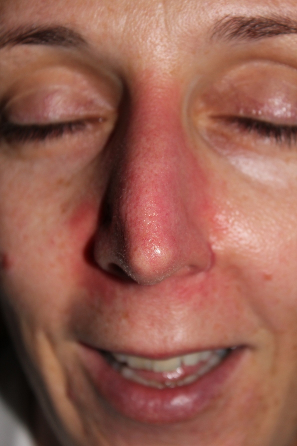 Fluroracil Efudex treatment follow-up for Basal Cell Carcinoma on nose